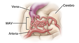 Primer plano de una malformación arteriovenosa (MAV) en el cerebro.