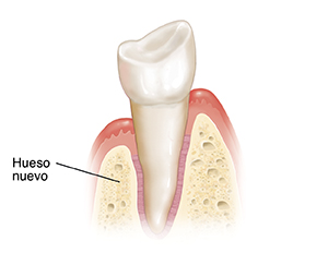 Diente en corte transversal del hueso y la encía. Ha crecido hueso nuevo donde se colocó el injerto.