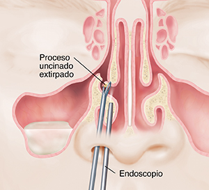 Primer plano de los instrumentos que se insertan en la nariz para extirpar un trozo de hueso.