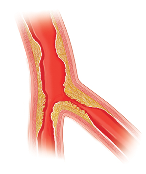 Cross section of artery with plaque buildup.