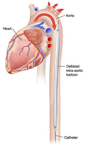 Side view of heart during systole showing deflated intra-aortic balloon pump in aorta.